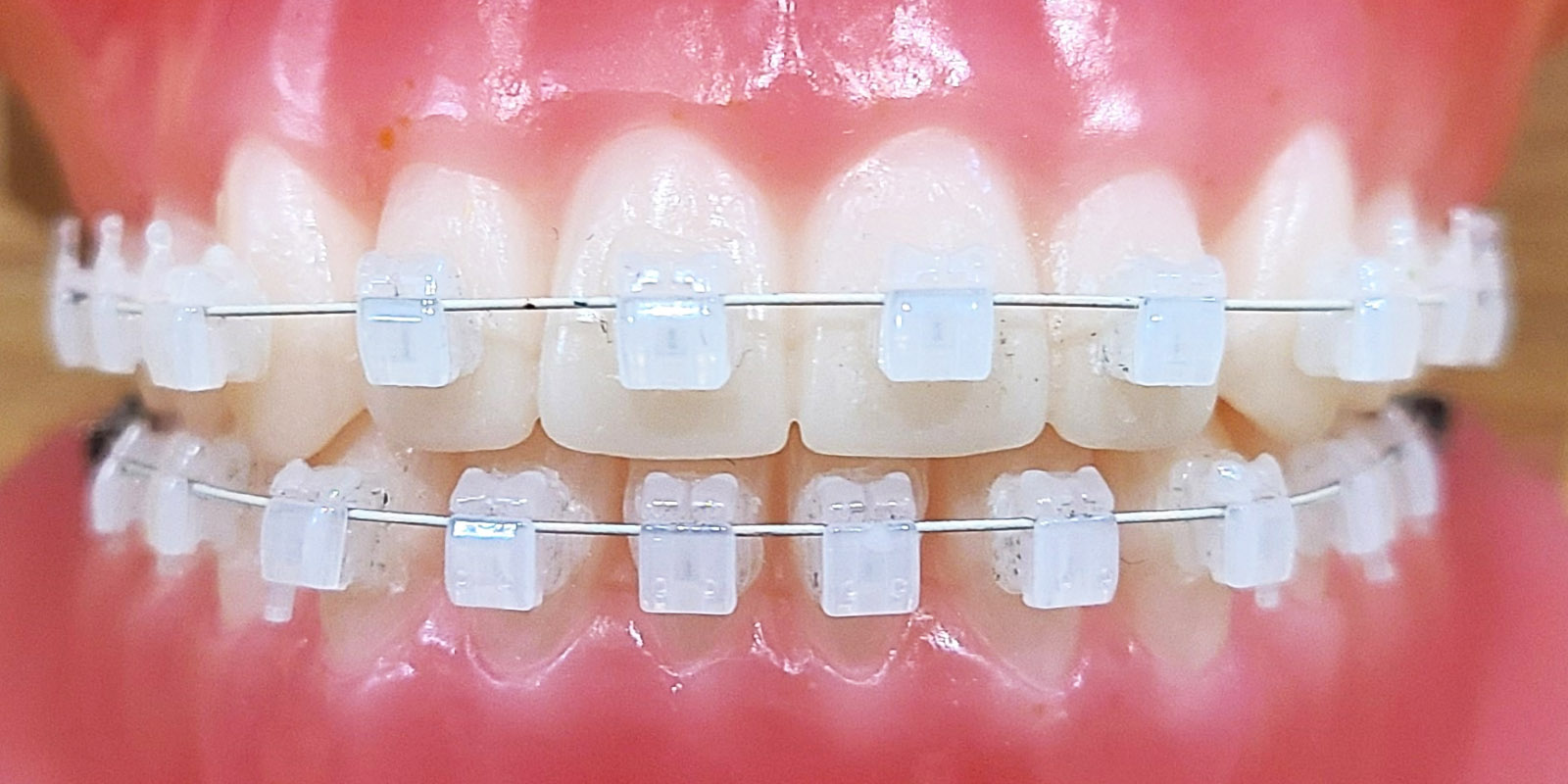 表側矯正 | 東京・港区の矯正歯科 | 青山外苑矯正歯科