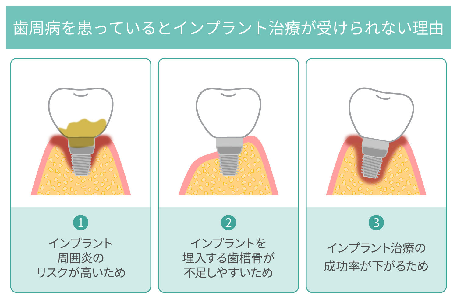 歯周病でもインプラント治療はできる？ 歯周病治療の方法や術後の注意