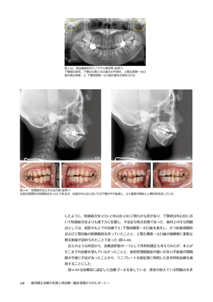 歯列矯正治療の失敗と再治療