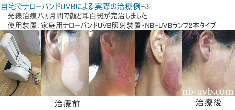 家庭用ナローバンドUVB(311nm)照射装置[個人輸入]｜在宅での(白斑